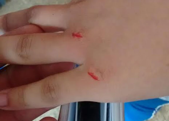 Estudante ficou com a mão ferida. Foto: Reprodução