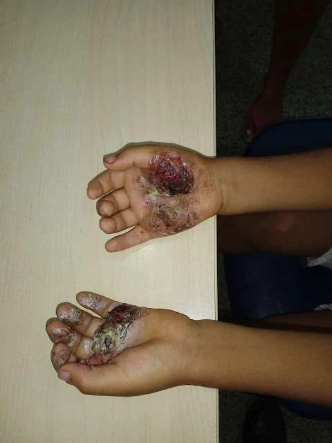 Tainá Setubal esquentou uma frigideira e queimou as mãos da criança, segundo informações do delgado regional de Pinheiro, Oséas Cavalcante. Foto: Divulgação.
