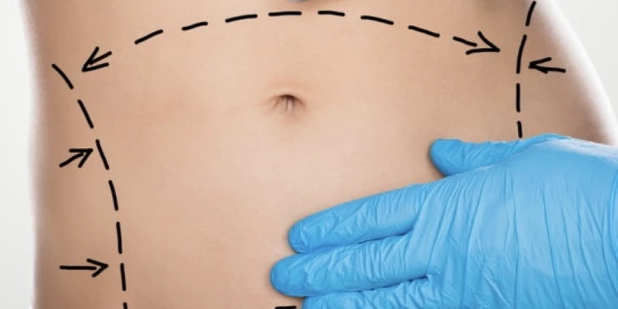 A mini abdominoplastia é uma versão da abdominoplastia, mas que é feita apenas retirando o excesso de pele na região supra púbica.