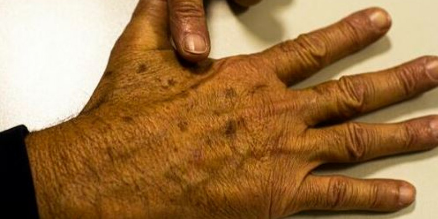 Câncer de pele: casos saltam de 4 mil para 72 mil