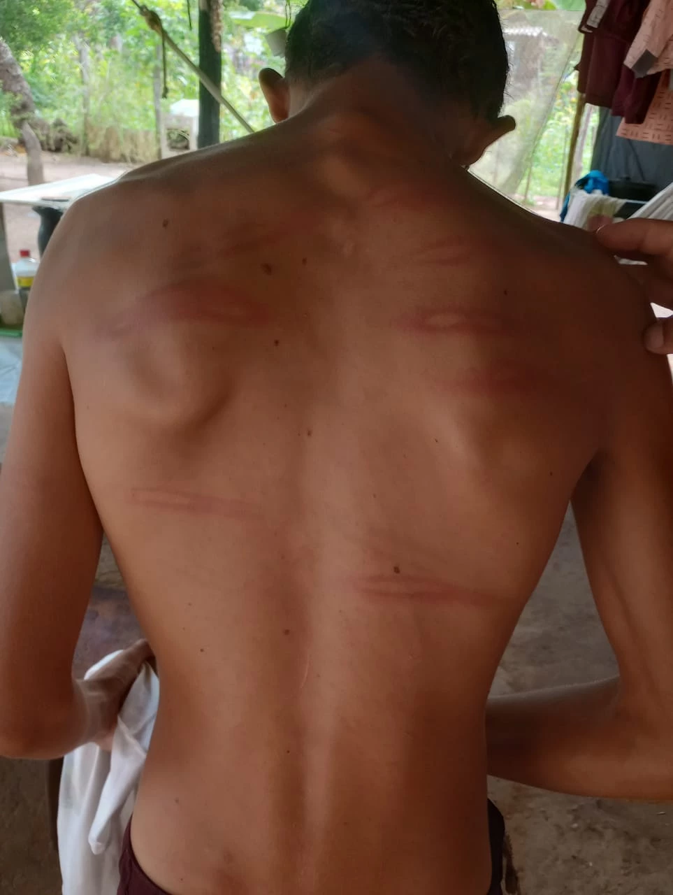 Marcas da agressão ficaram no corpo do adolescente. (Foto: Divulgação / Polícia Civil)