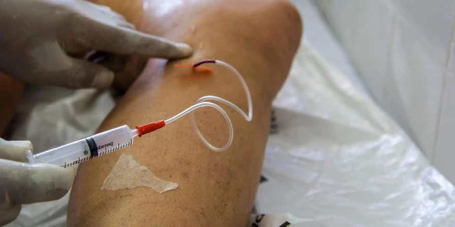 Foram 45,8 mil mulheres internadas por varizes em 2022.