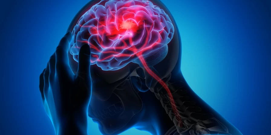 O acidente vascular cerebral ocorre quando vasos que levam sangue ao cérebro entopem ou se rompem.