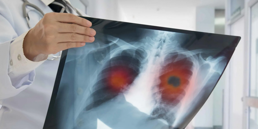 Brasil terá 781 mil casos de câncer por ano