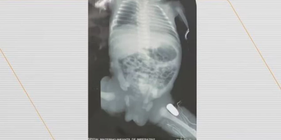 Bala ficou alojada na perna do bebê.