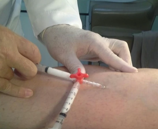 Escleroterapia ecoguiada de espuma é tratamento eficaz contra varizes